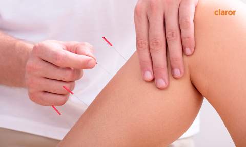 Acupuntura para runners