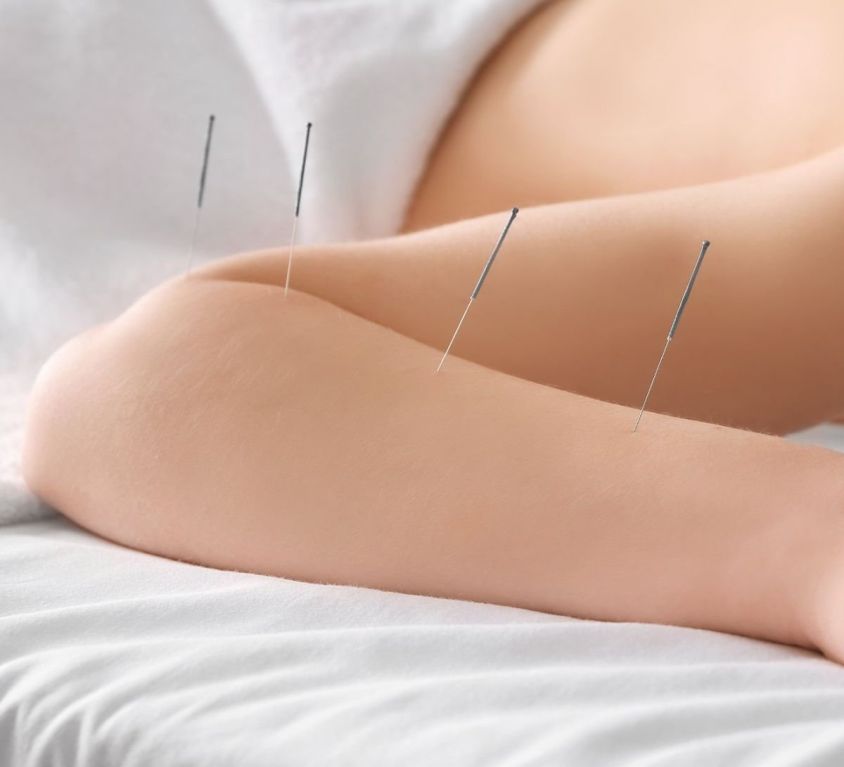 Acupuntura